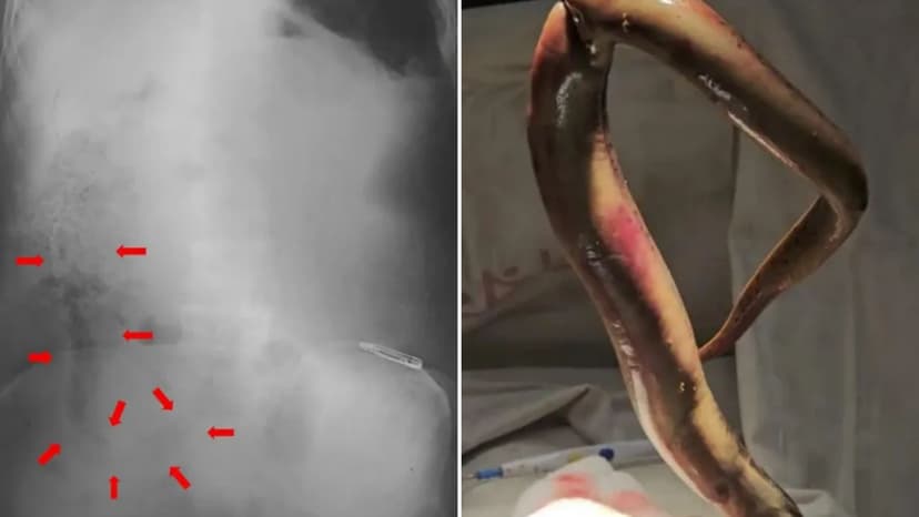 Eel Up Man's Backside: Fisherman's Shocking Ordeal