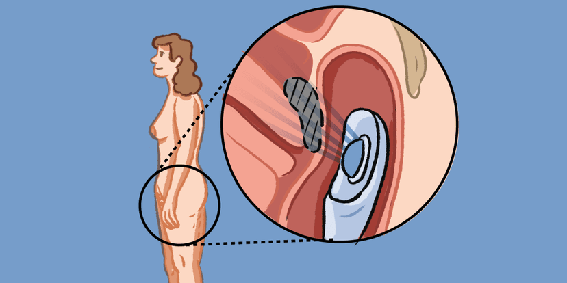 Digestive Endometriosis Breakthrough: Ultrasound Probe Offers Relief