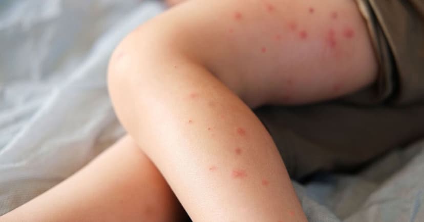 Enfield Measles Alert: 34 Children Infected