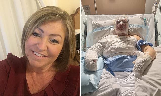 Ethanol Fireplace Explodes, Leaving Woman Disfigured