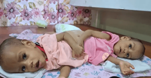 Fiji Twins' Life-Saving Surgery in Saudi Arabia