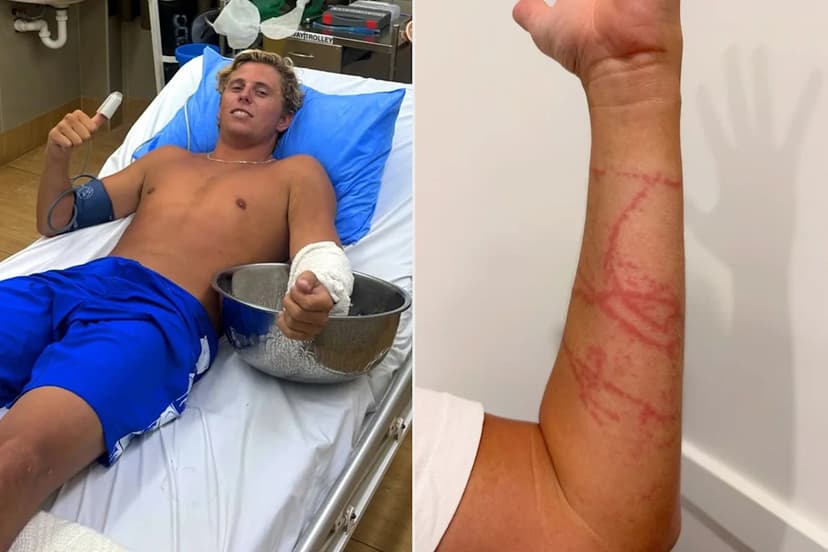Surfer Stung by Deadly Jellyfish in Fiji Paradise