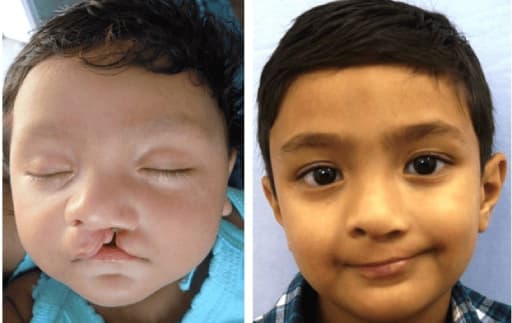 Hyderabad gets 50 free cleft surgeries