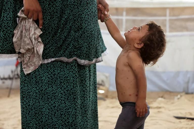 Gaza Camps: Chickenpox Outbreak Strains Resources