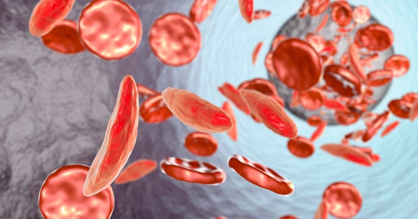 Gene Therapy Cures Teen's Sickle Cell Pain