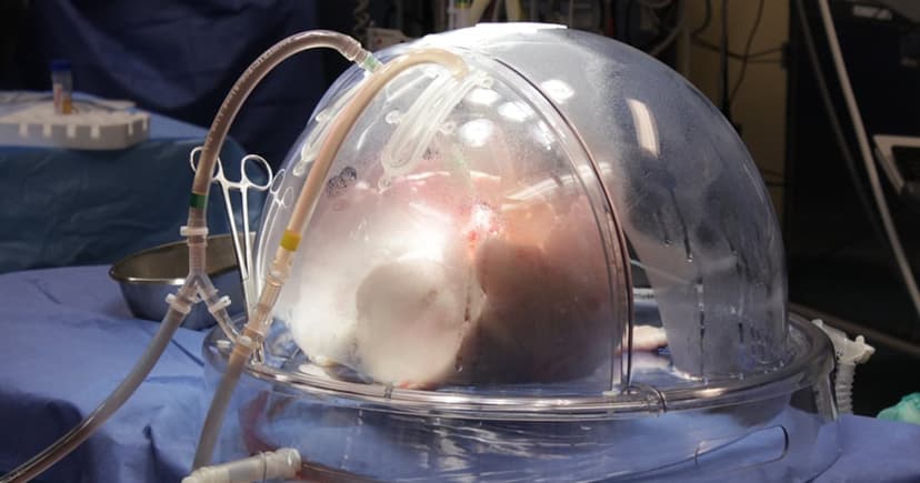 New Gene Therapy Could Make Donor Lungs 'Yours'