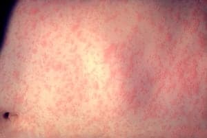 Georgia Reports Second Measles Case This Year