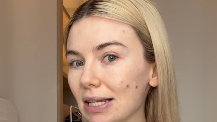 Georgia Toffolo's acne battle: Natural skin revealed