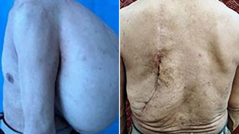 Giant 22lb Lump Removed From Man's Back