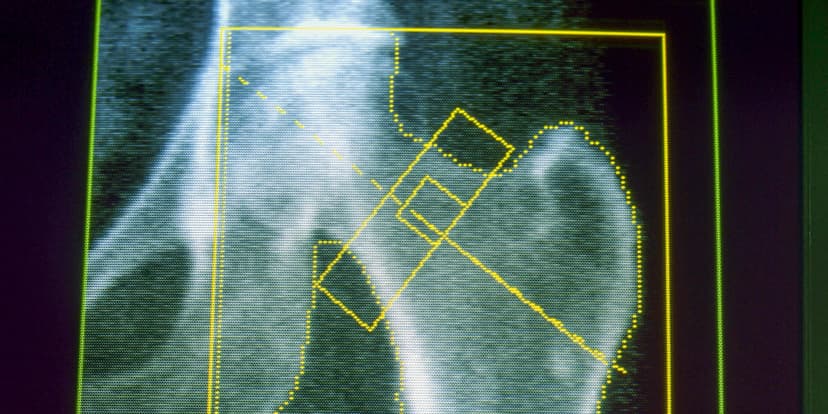 GLP-1 Drugs Linked to Bone Health Risks