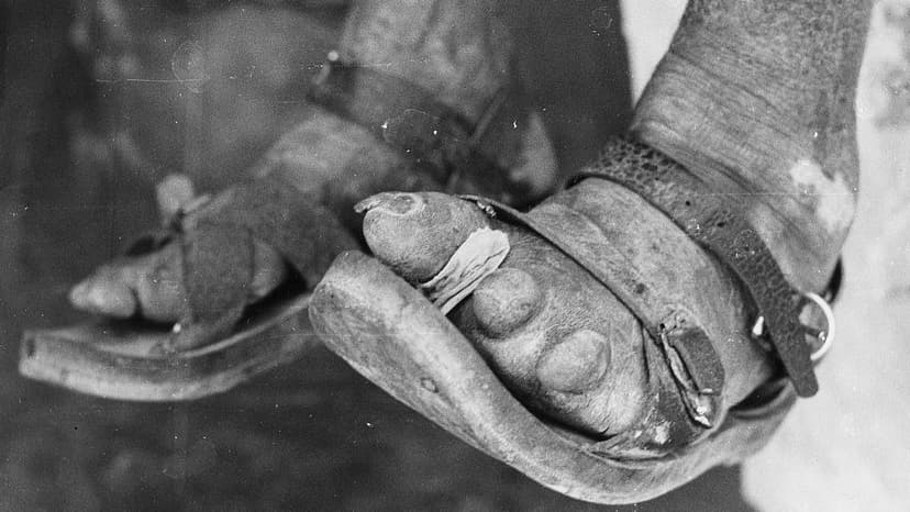 Leprosy's Cure Emerged From Dye Industry