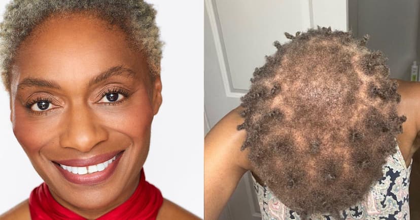 Actress sues Harvard's theater for permanent hair loss