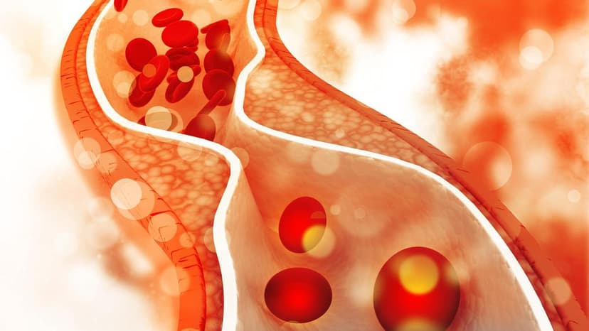 Near-Death Scare Convinces Patient to Take Statins