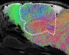 Mice Grow Human Brain Halves for Disease Research