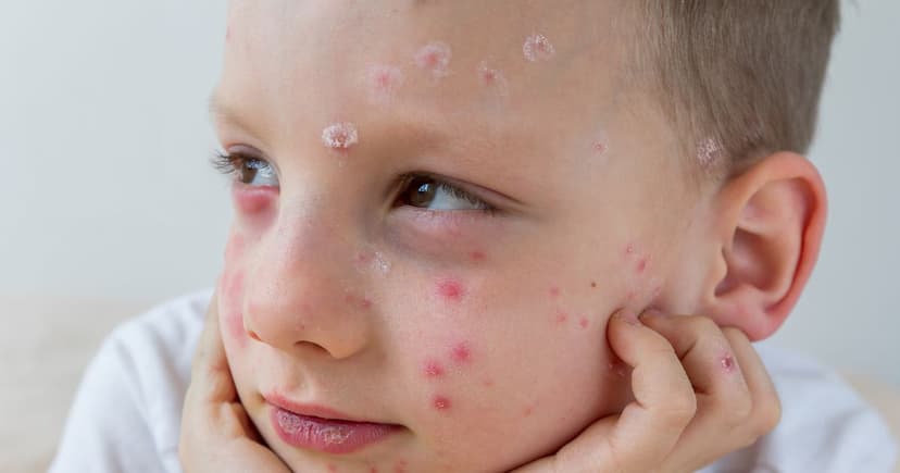 Contagious Skin Rash Mimics Eczema, Beware!