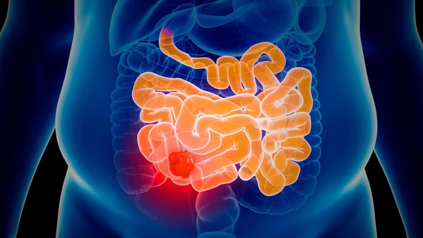 Home Test Spots More Cancers Early