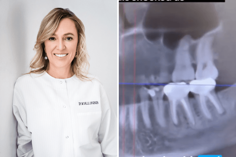 Viral X-Ray Shows Infected Teeth Linked to Cancer