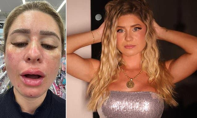 Face ID Fail: Influencer Locked Out After Extreme Fillers