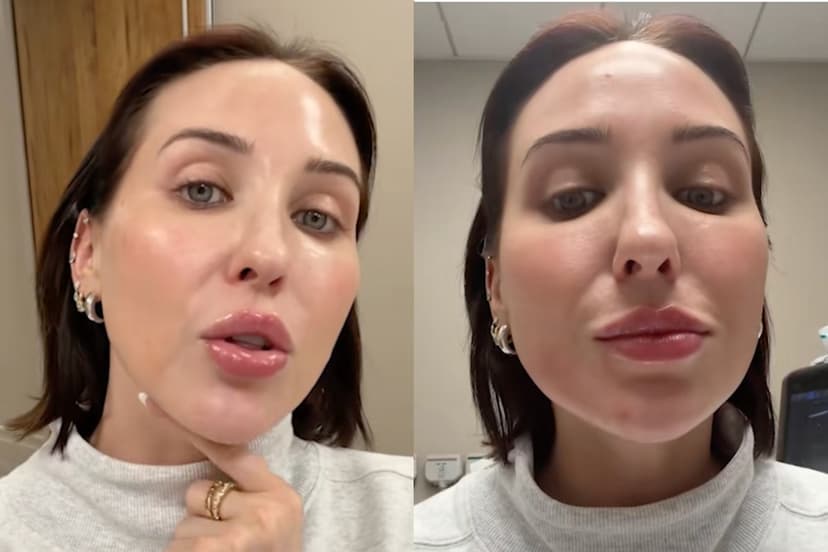 Jaclyn Hill Dissolves Face Filler After Migration