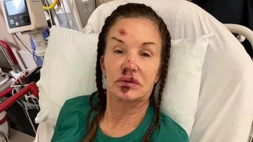 Janice Dickinson's Fall: Who's to Blame?