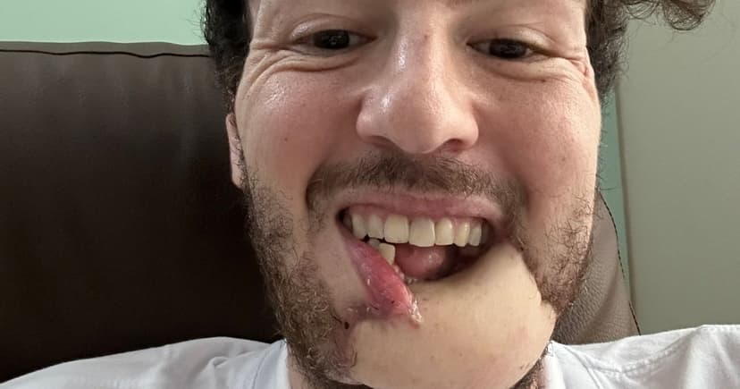 Jaw Rebuilt With Leg Bone After Phone Theft Fall