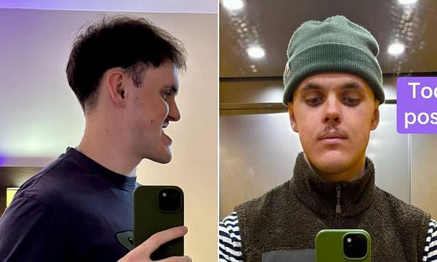 Jaw Surgery Transforms Man, Friends Barely Recognize Him