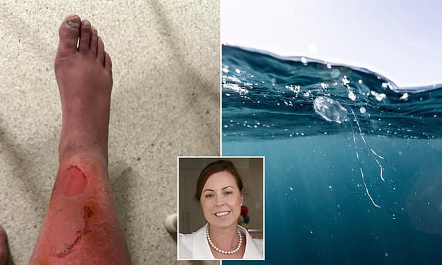 Perth Mum's Leg Saved After Terrifying Jellyfish Sting