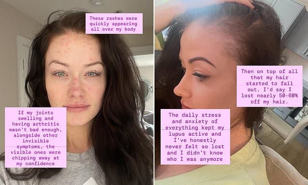 Jess Impiazzi's Brave Lupus Journey: Rashes to Resilience