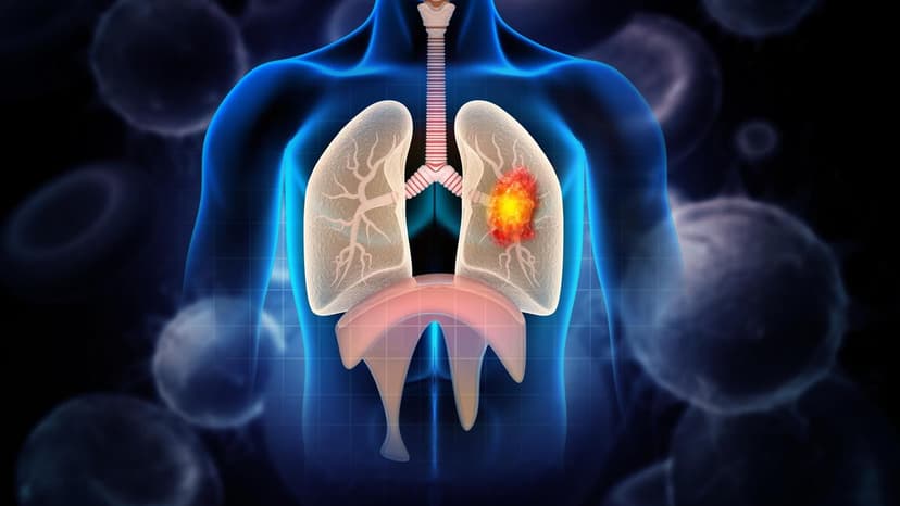 Karnataka Lung Cancer Cases Rise Sharply