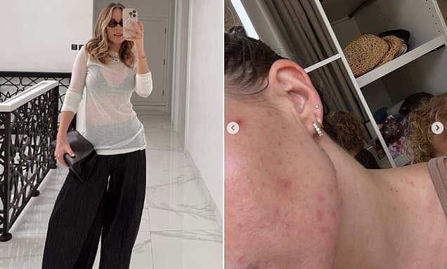 Kate Ferdinand Battles Acne Amid Dubai Life Shift