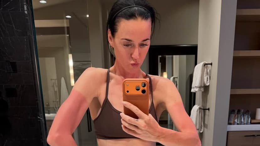 Katy Perry's painful sunburn post-ski trip