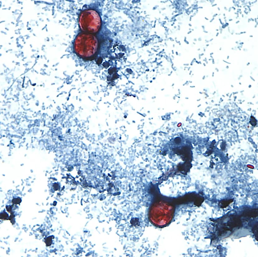 Kentucky Cyclosporiasis Outbreak: 100 Cases Reported