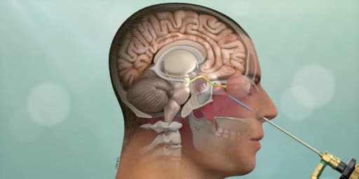 Keyhole Brain Surgery: Less Inflammation, Better Future