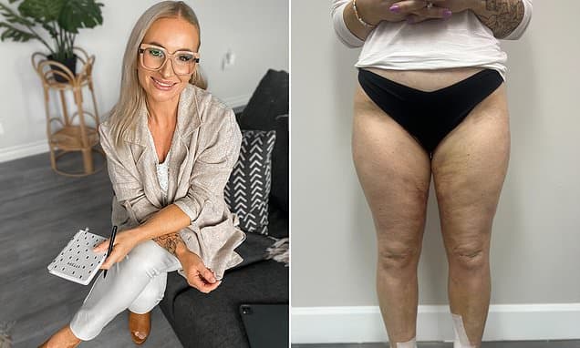 From 'Lazy' to Healed: Laura Kerr's Lymphedema Journey