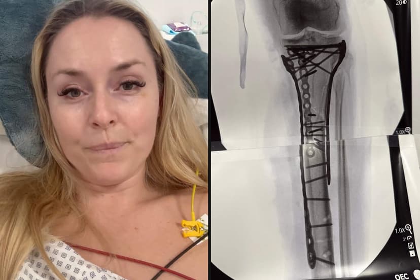 Vonn's Grueling Recovery: More Than Just Broken Bones