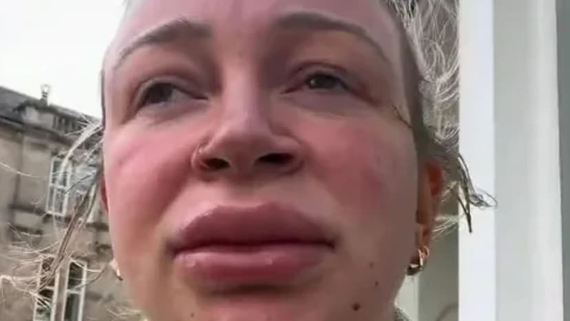 Lip Dissolving Gone Wrong: Mum's Swollen Pout Horror