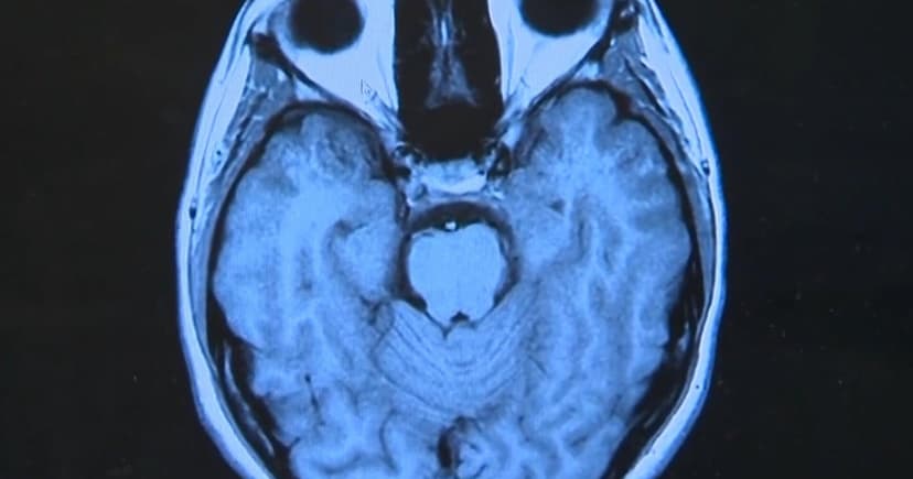 Long COVID's Bumpy Road: New Study Reveals Recovery Patterns