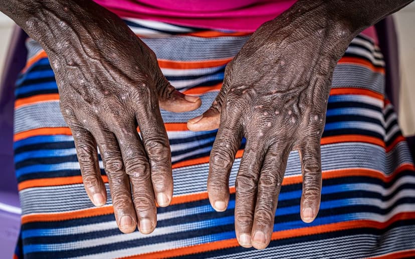 Madagascar Splits Vaccines to Combat Mpox Outbreak