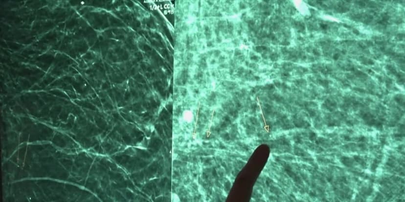 Mammograms Reveal Hidden Heart Risk in Women