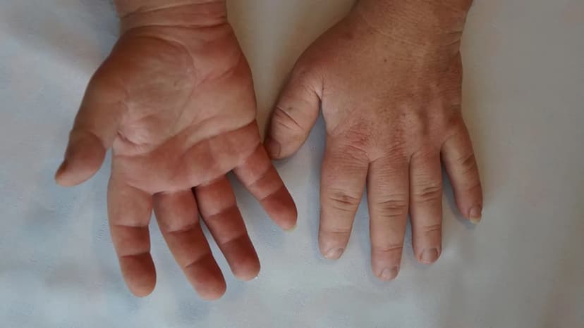 Marea's MAR002 Shows Strong IGF-1 Reduction in Trials