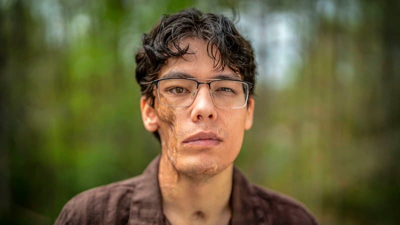 Marine's Face Rebuilt After Fungal Infection