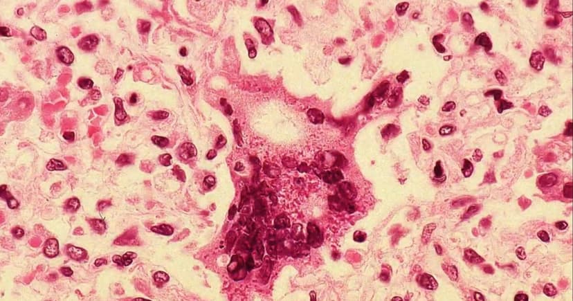 Fourth Measles Warning Issued in Maryland