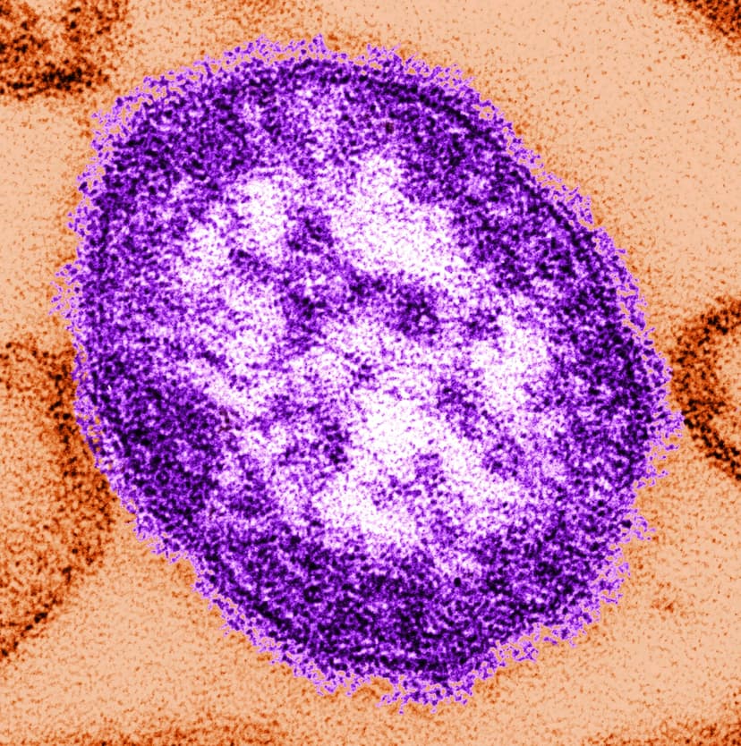 Boston Area Adult Contracts Measles After Travel