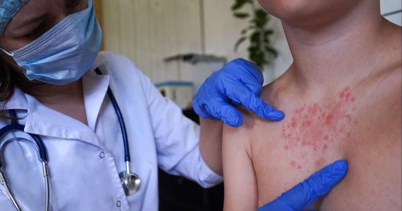 Second Measles Case Confirmed at Broomfield High