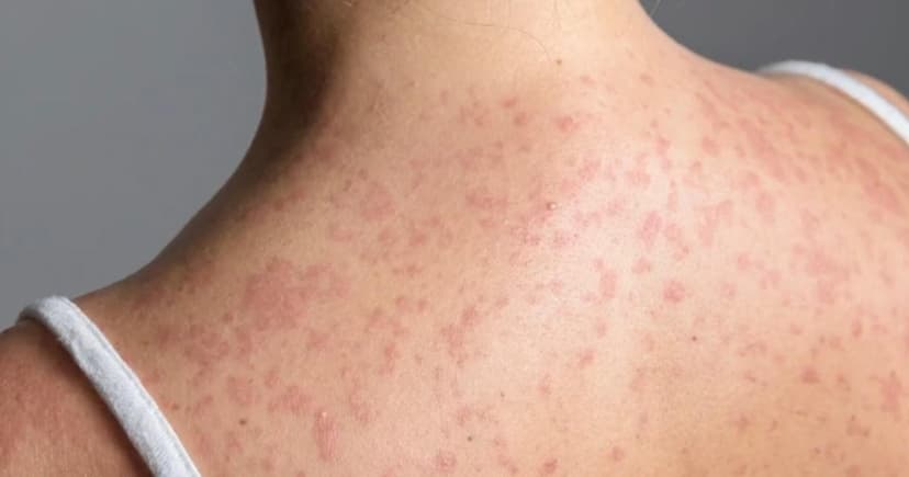 Measles Returns: First Case in San Bernardino County Since 2023