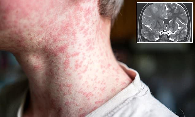 Measles Scars: Deadly Brain Disease Lurks Years Later