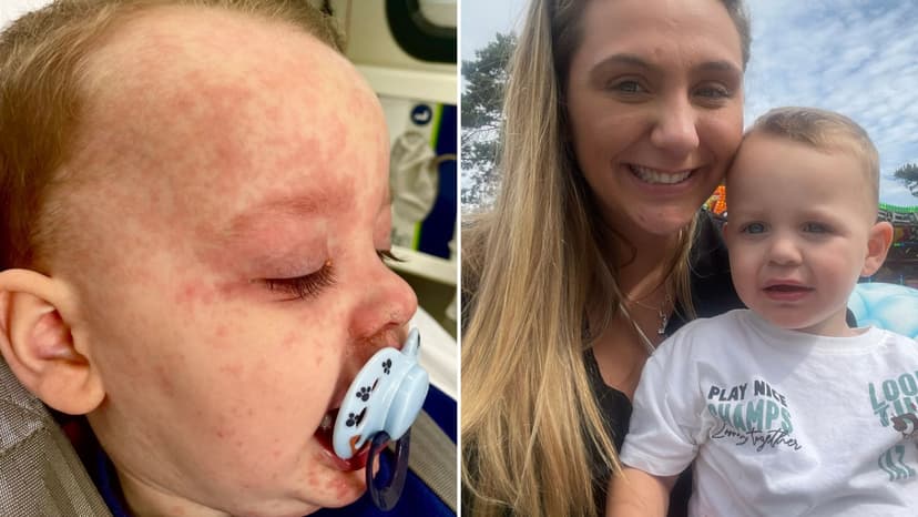 Devastating Measles: Mum's Warning After Son's Near-Fatal Illness