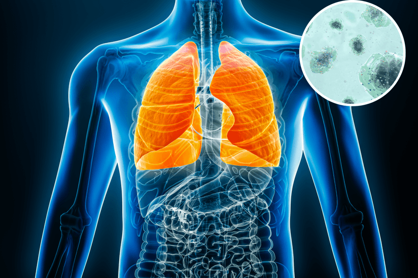 Plastic Breath: Microplastics Found in Human Lungs