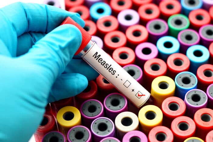 North Dakota Measles Cases Surge, Hospitalizations Rise