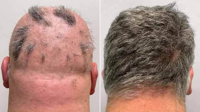 UK Approves Groundbreaking Alopecia Treatment